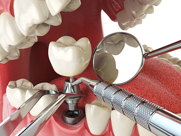 Best Emergency Tooth Extraction in Berry Hill, TN